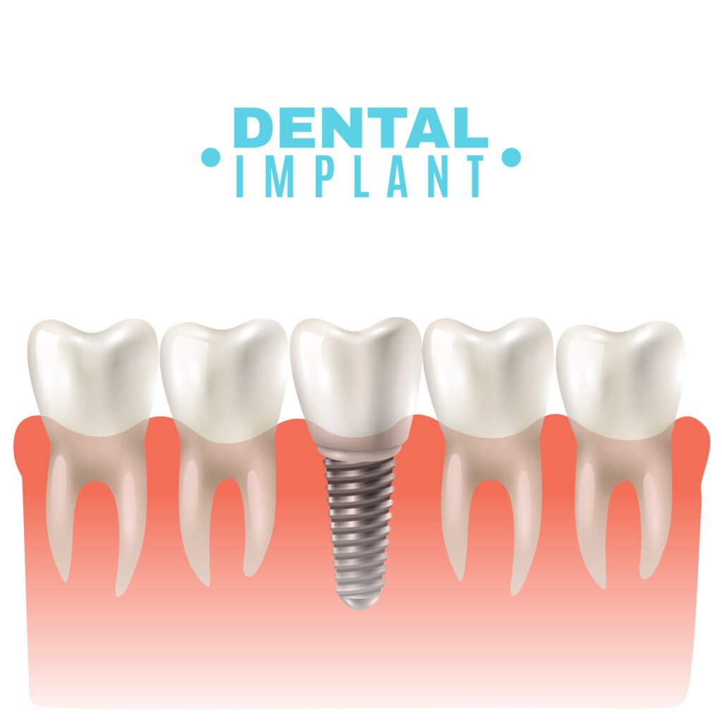 all 6 dental implants