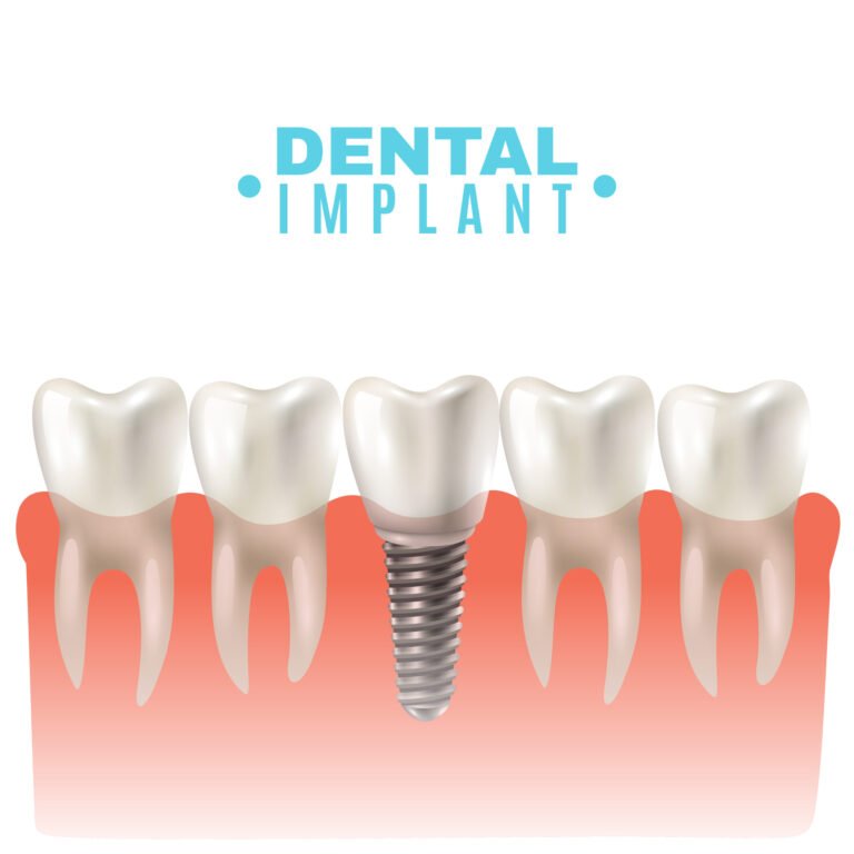 all 6 dental implants
