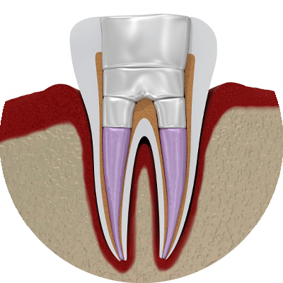 3d model of rootcanal retreatment