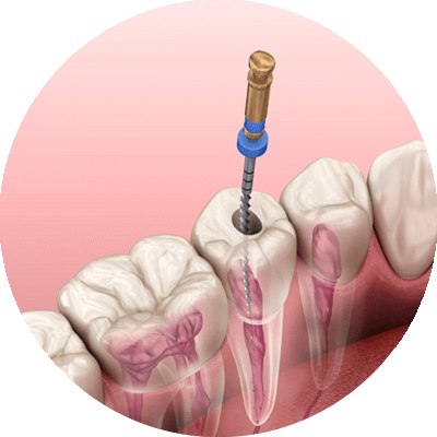 3d model of rootcanal treatment