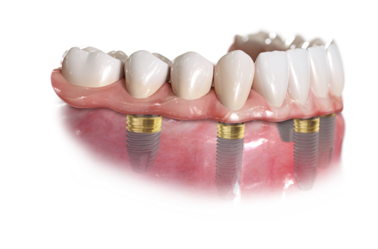 all-on-4 dental implants