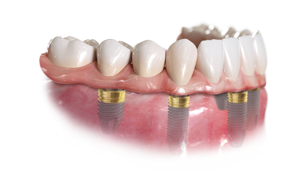 all-on-4 dental implants