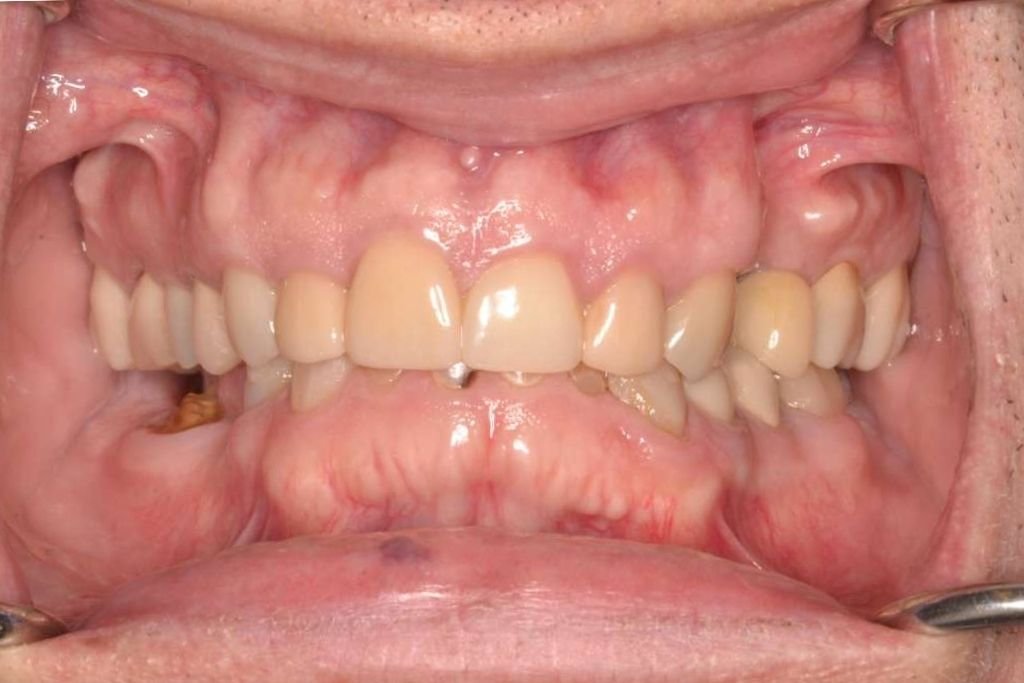 before all-on-4 treatment