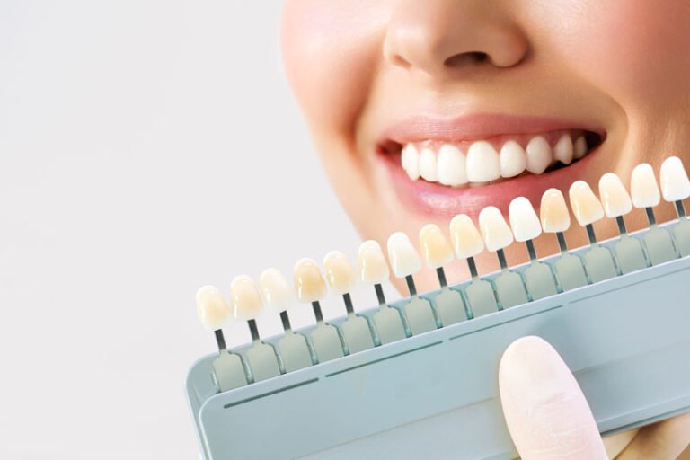 a patient that is getting color matching for veneers