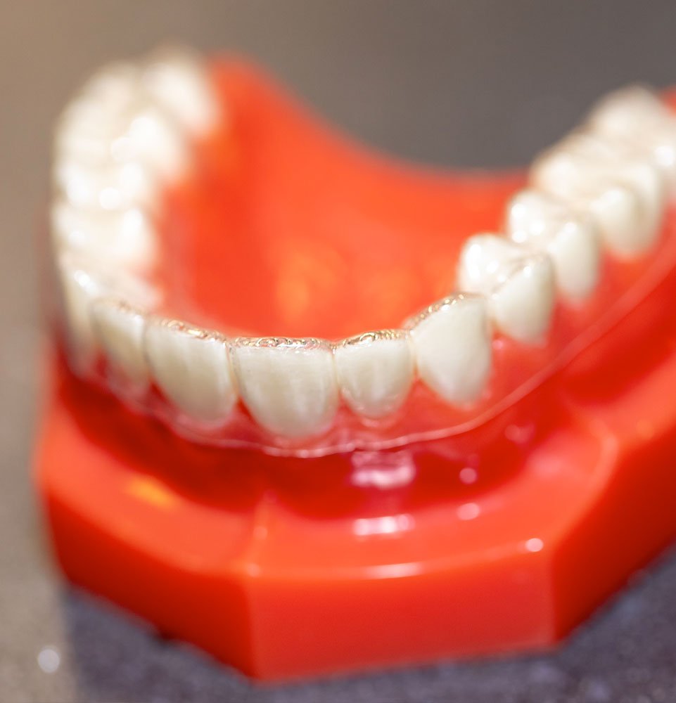 custom aligner being fitted