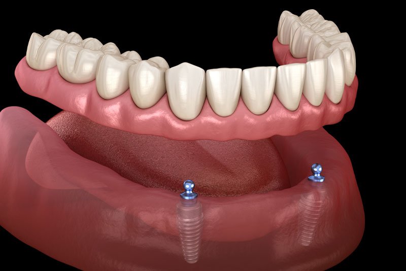 implant supported denture model