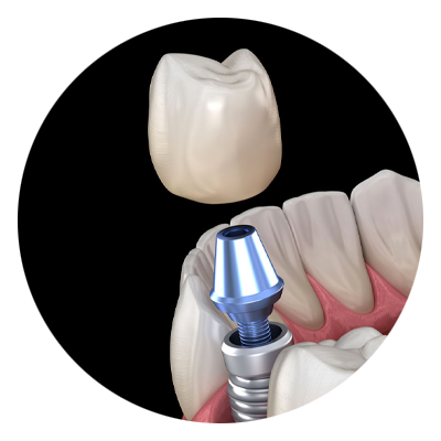 implant 3d model