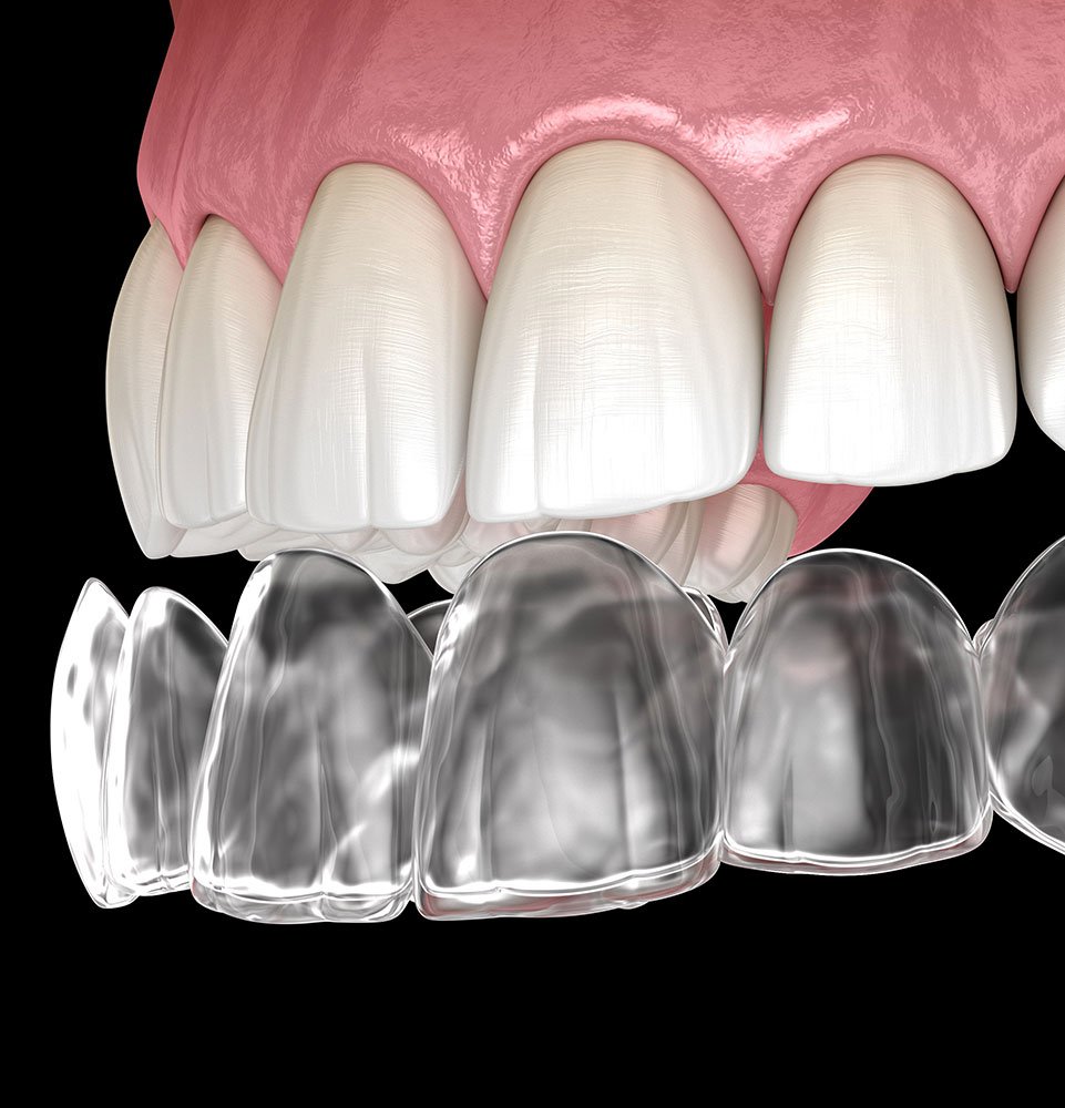 invisalign clear aligner 3d model