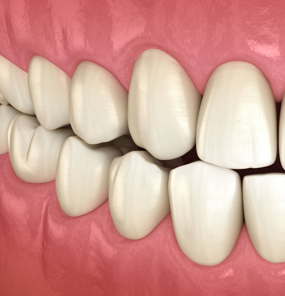 Occlusal Adjustment