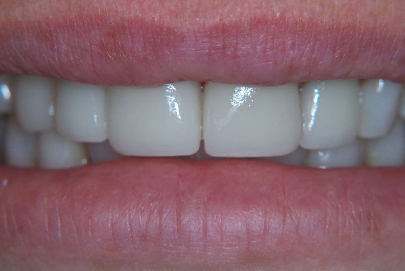 after dental treatment