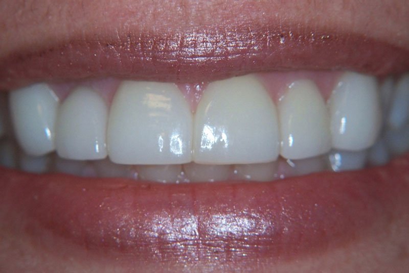 after dental treatment