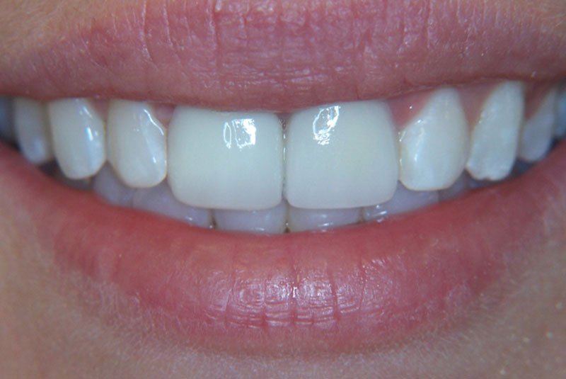 after dental procedure