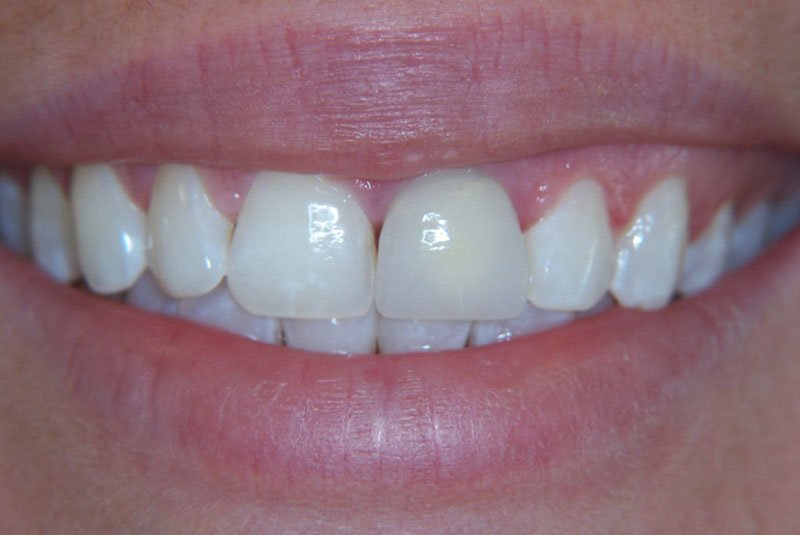 before dental procedure