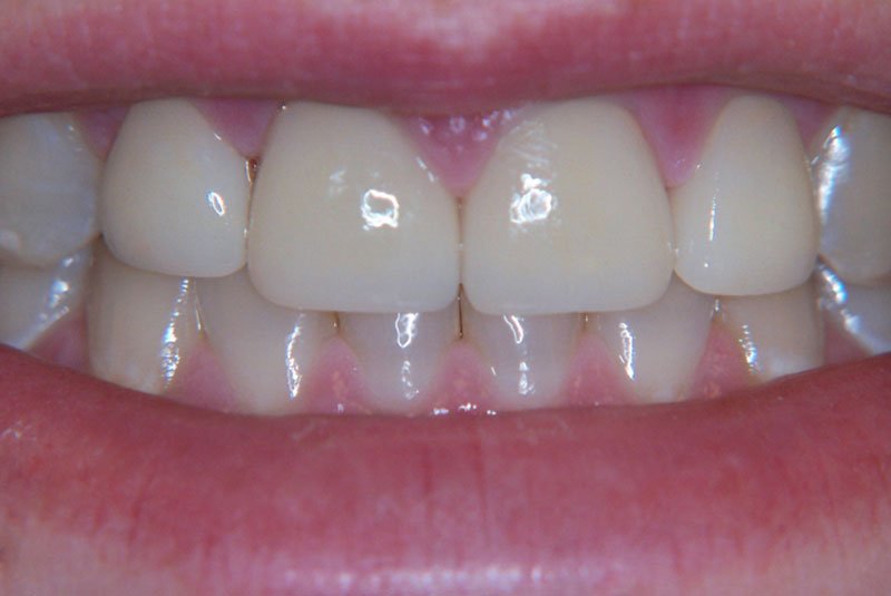 after dental procedure