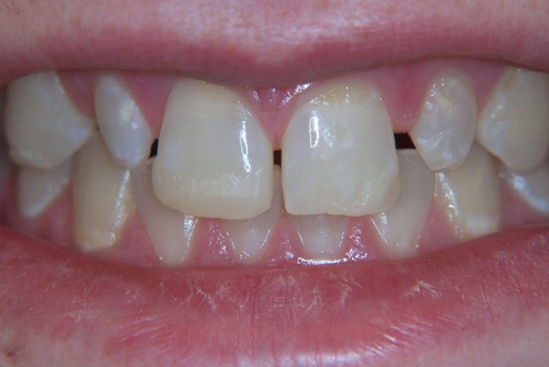 before dental procedure