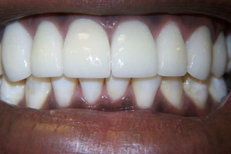 after dental treatment