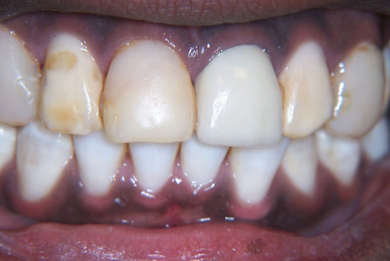 before dental treatment