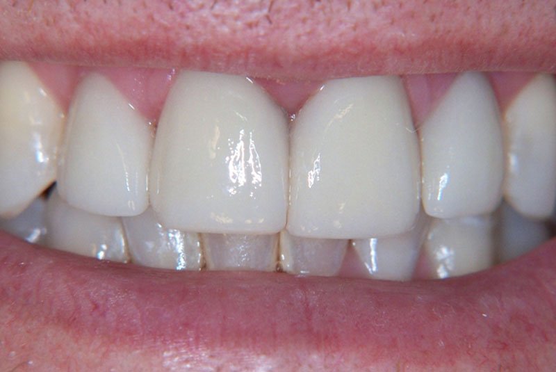 after dental procedure