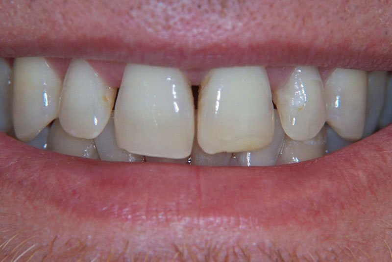 before dental procedure