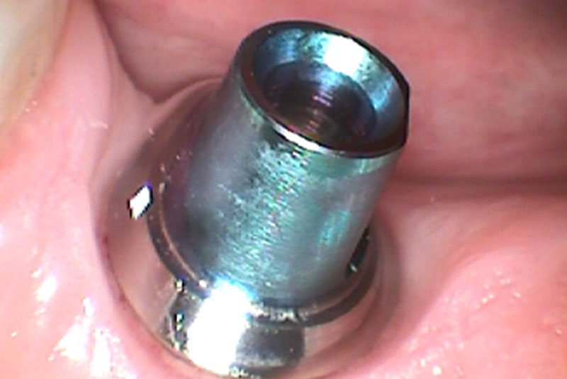 after dental implant