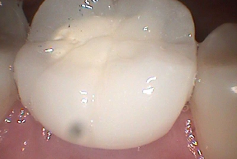 before dental implant