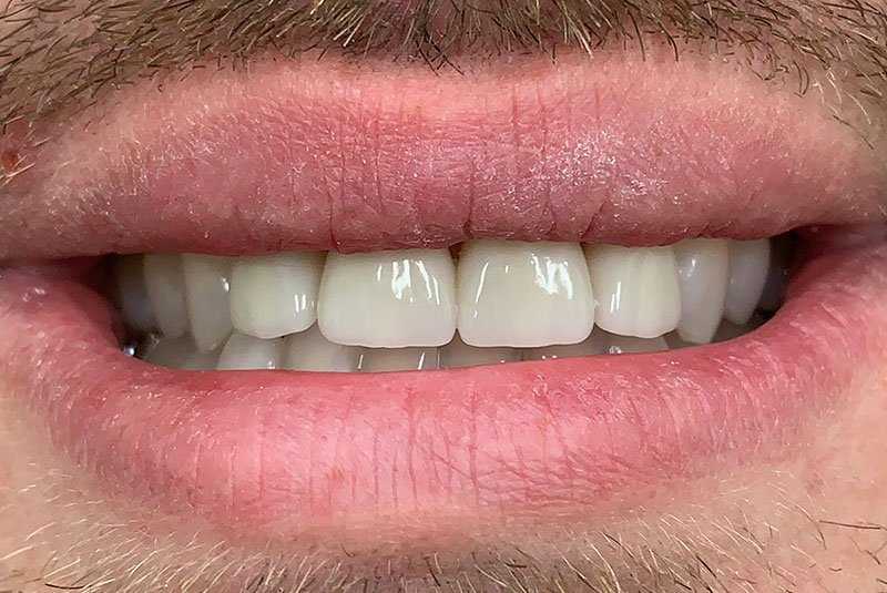 after dental treatment