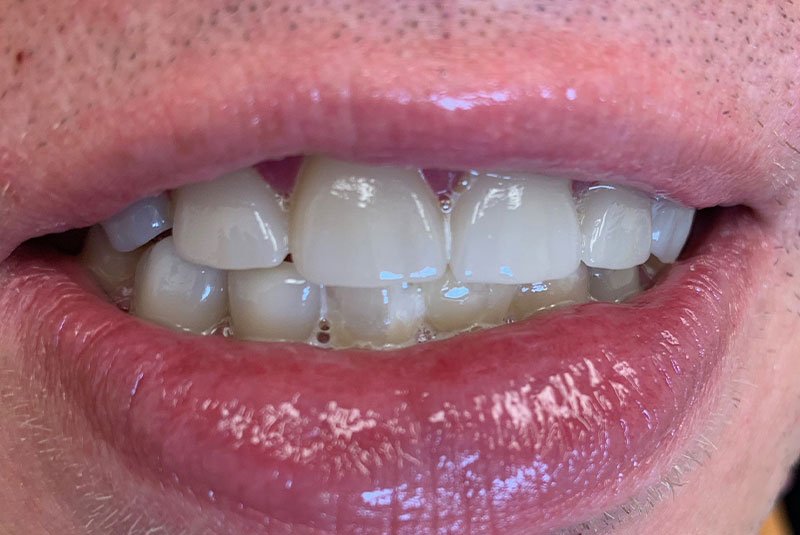 after dental treatment