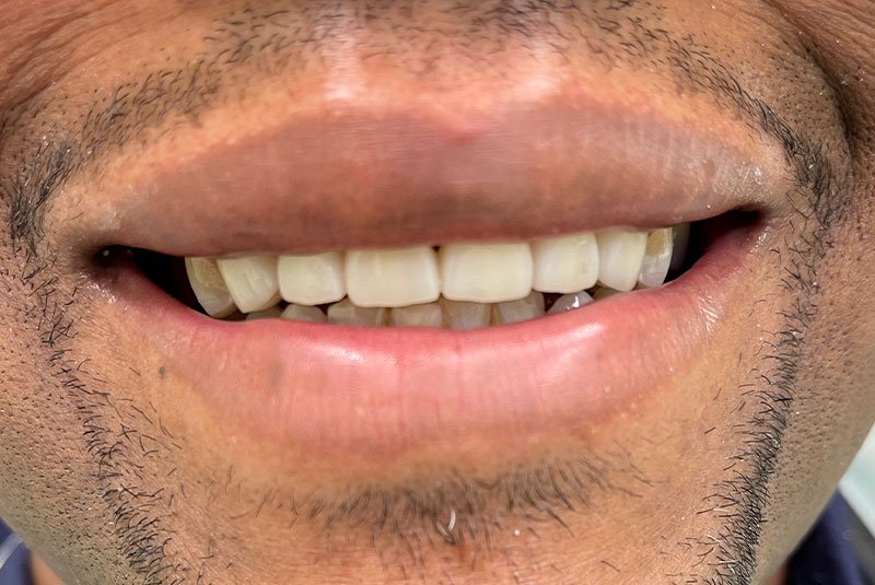 after dental procedure