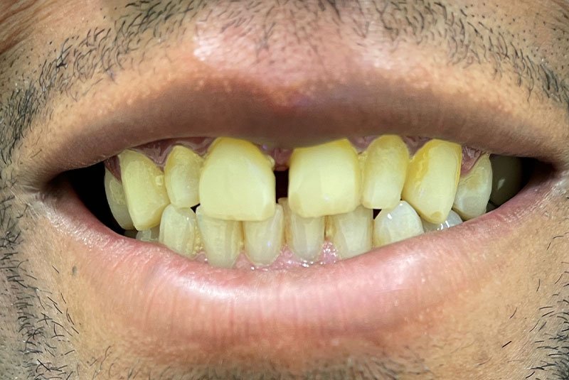 before dental procedure