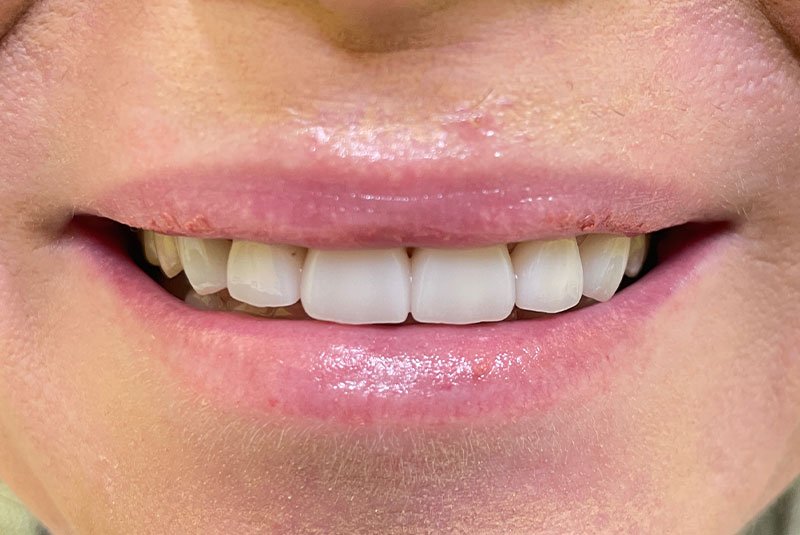after dental procedure