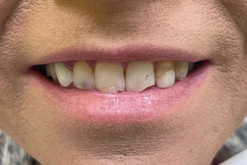before dental procedure