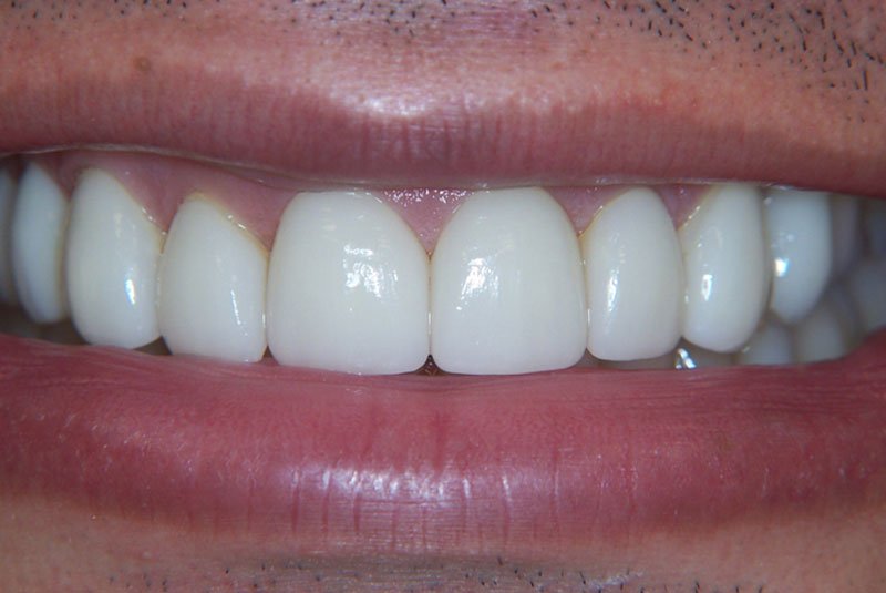 after dental treatment