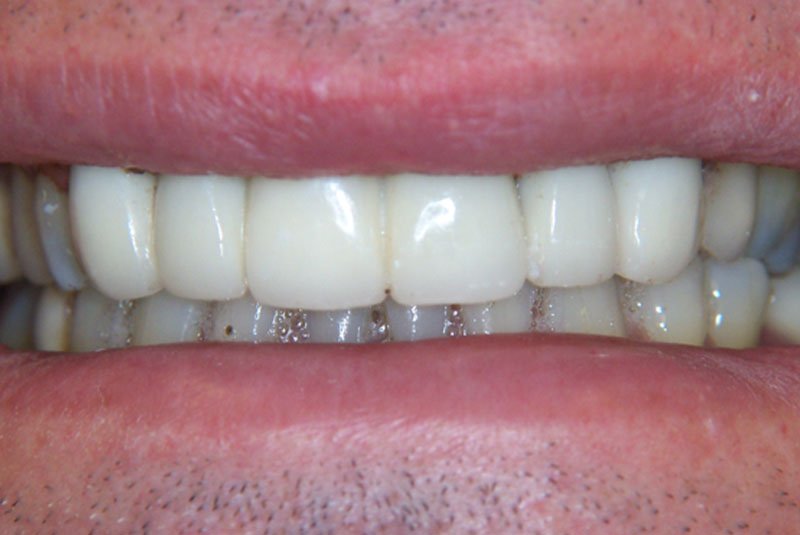 after dental procedure