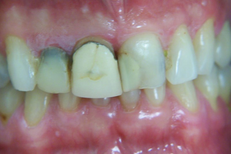 before dental procedure