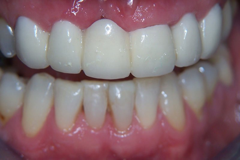 after dental procedure
