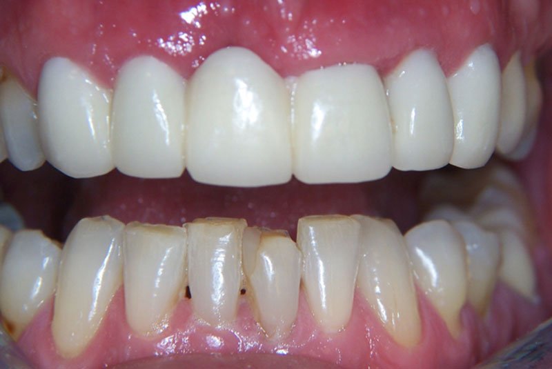 before dental procedure
