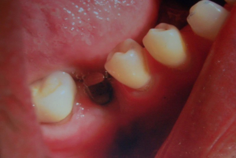 before dental implant