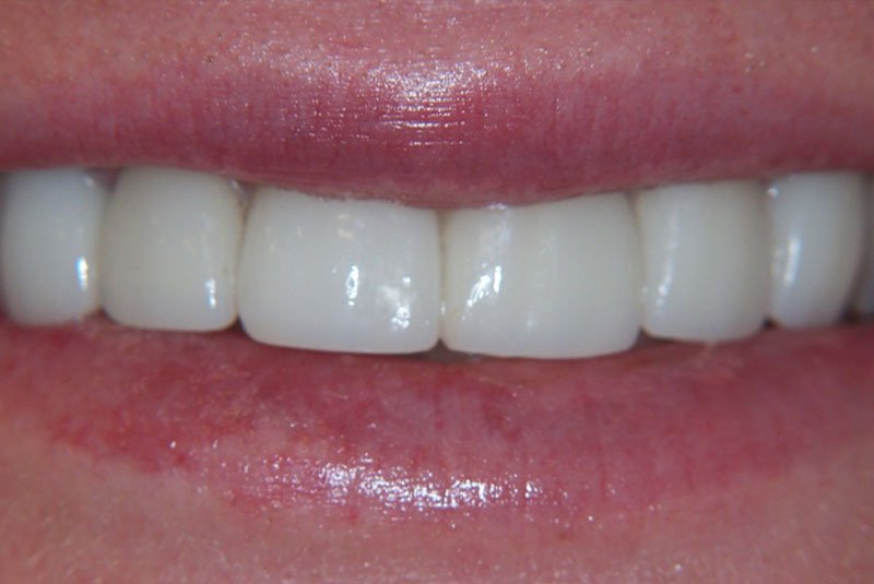 after dental treatment