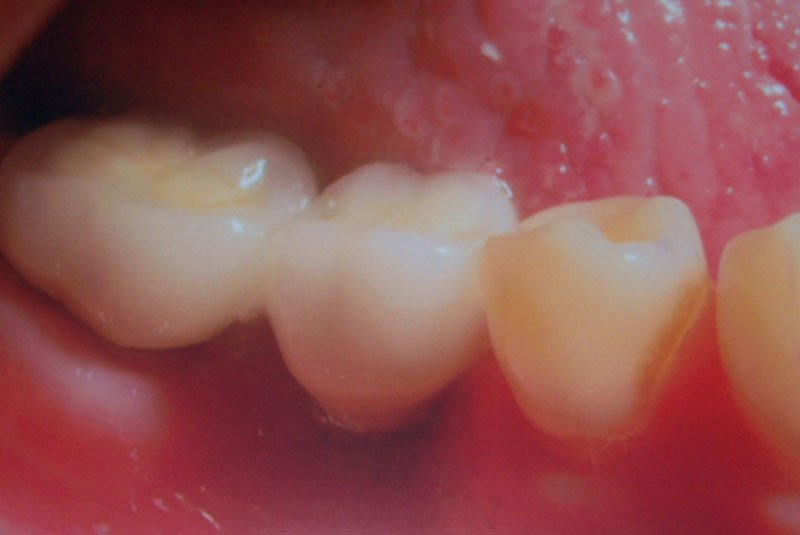 after dental implant