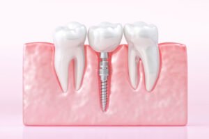 root canal in Burlington