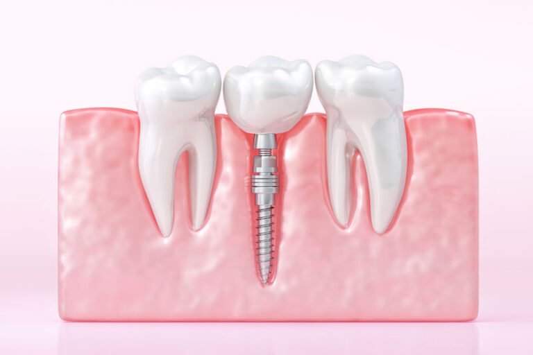 root canal in Burlington