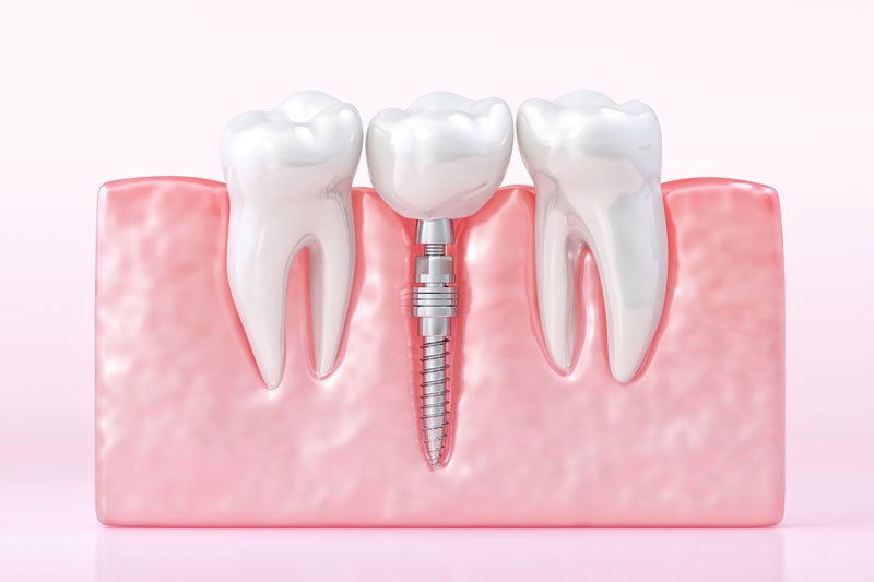 root canal in Burlington