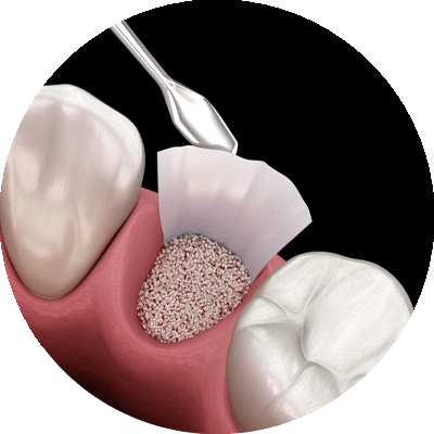socket preservation 3d model