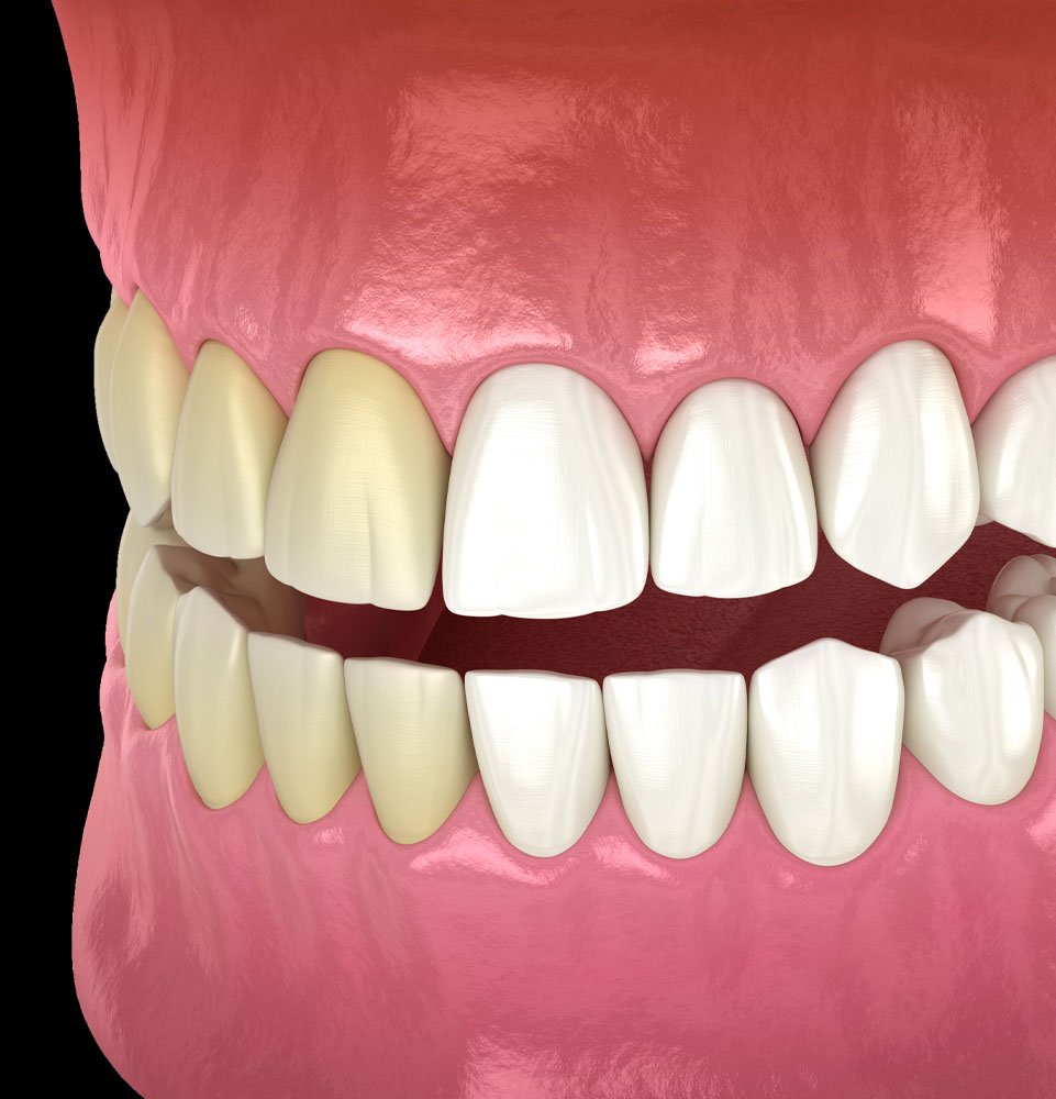 Teeth Whitening