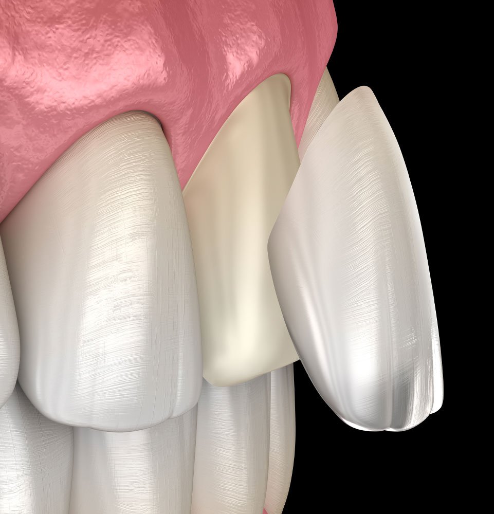 Porcelain Veneers